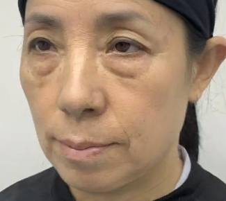 去眼袋手术