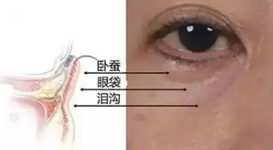 去眼袋手术