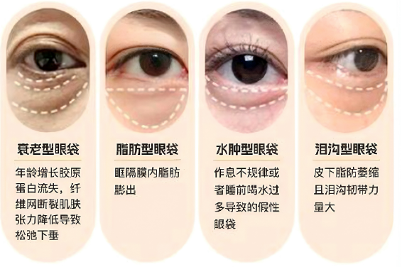 去眼袋手术