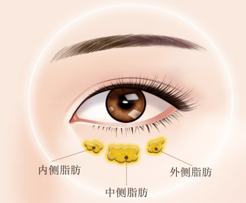 去眼袋手术
