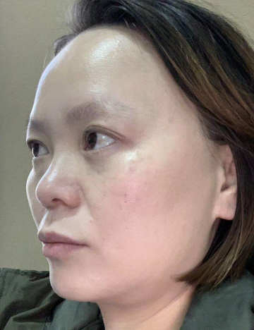去眼袋手术