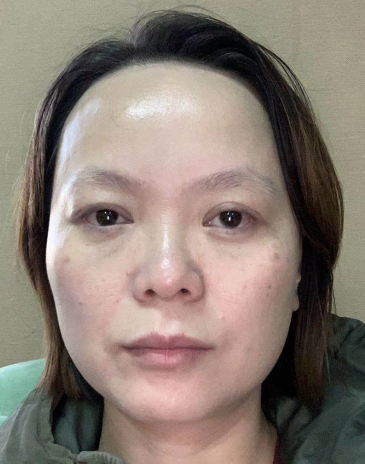 去眼袋手术