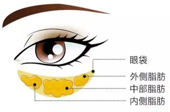 去眼袋手术