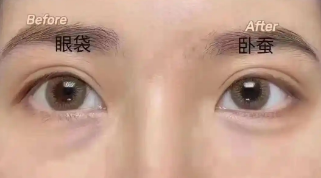 去眼袋手术