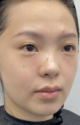 去眼袋手术
