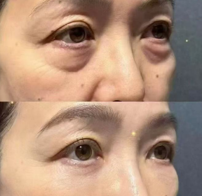 眼袋