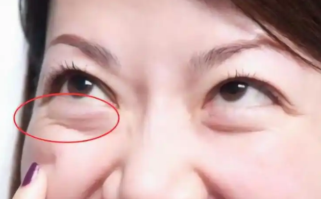 眼袋