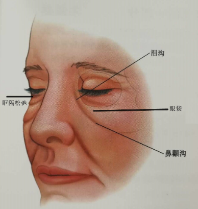 去眼袋手术