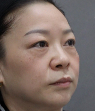 去眼袋手术