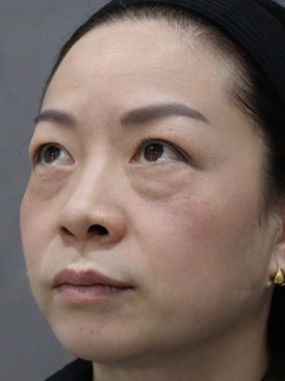 去眼袋手术