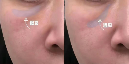 去眼袋手术