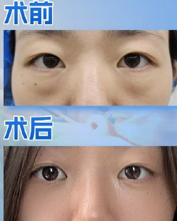 去眼袋手术