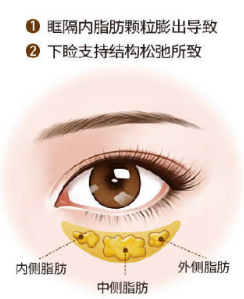 眼袋