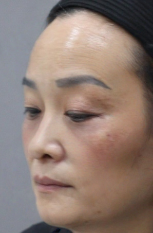 去眼袋手术