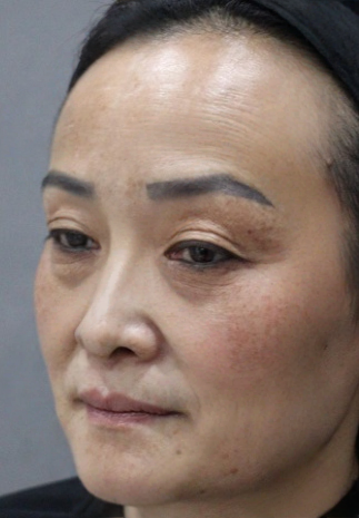 去眼袋手术