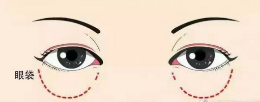 眼袋