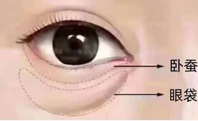 眼袋