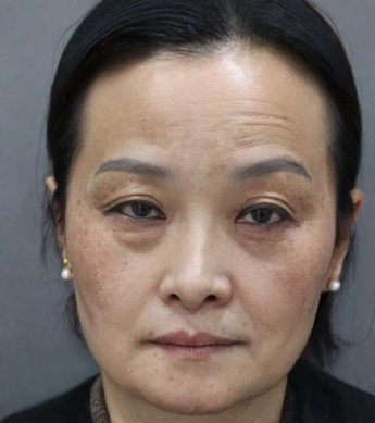 去眼袋手术