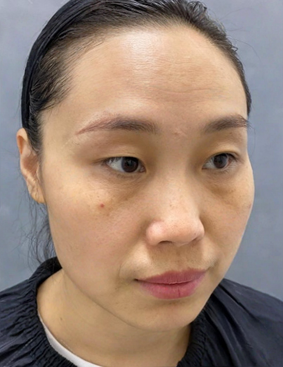 去眼袋手术