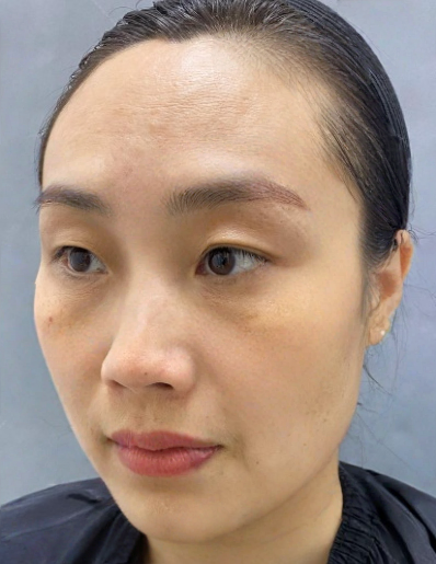 去眼袋手术