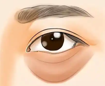眼袋