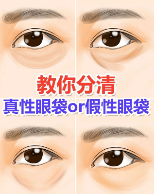 去眼袋手术