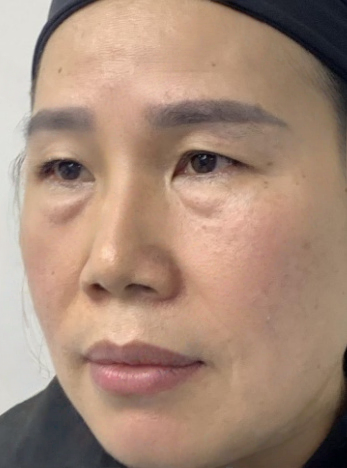 去眼袋手术