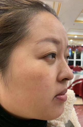 去眼袋手术