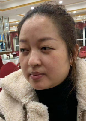 去眼袋手术