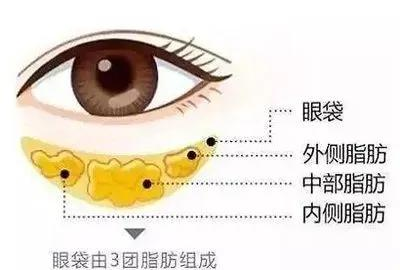 去眼袋手术