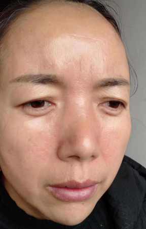 去眼袋手术