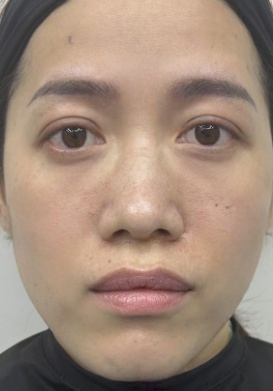 去眼袋手术