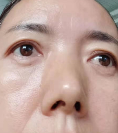 去眼袋手术