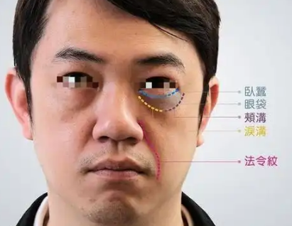 去眼袋手术