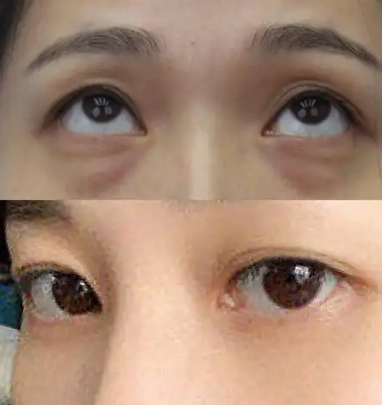 去眼袋手术