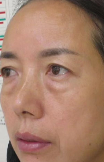 去眼袋手术