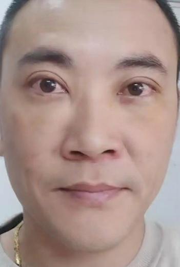 去眼袋手术