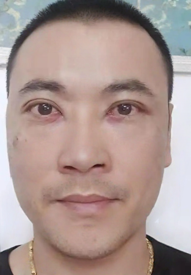 去眼袋手术