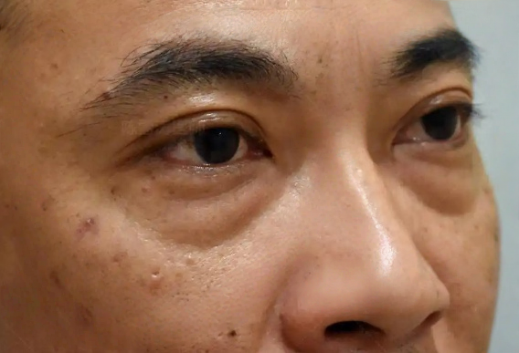 去眼袋手术