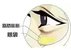 去眼袋手术
