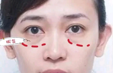 去眼袋手术