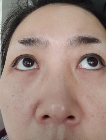 去眼袋手术