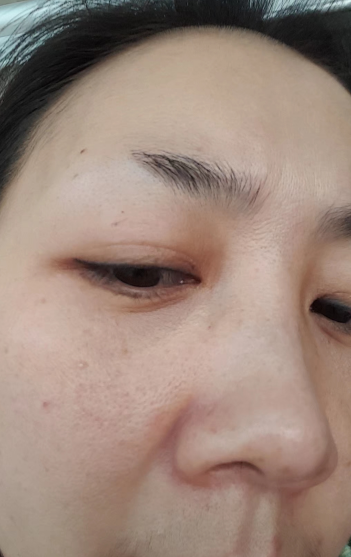 去眼袋手术