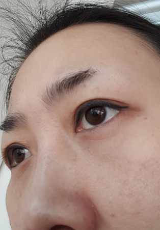 去眼袋手术