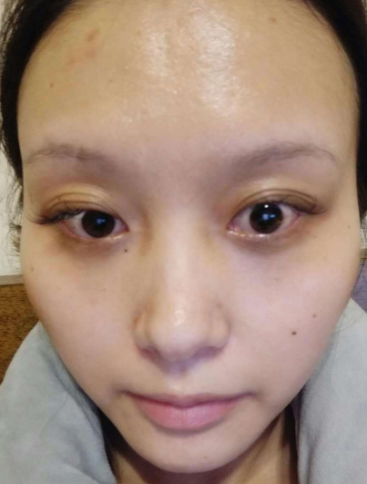去眼袋手术
