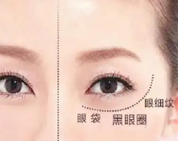 去眼袋手术