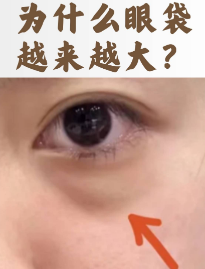 去眼袋手术