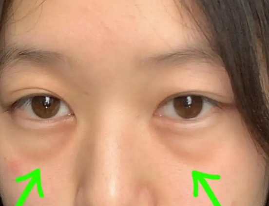 去眼袋手术