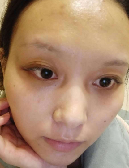 去眼袋手术