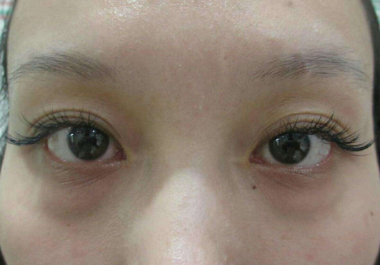 去眼袋手术